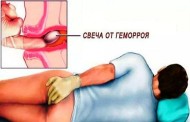 Как лечат геморрой у мужчин?