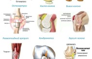 Болезни коленного сустава: классификация, принципы лечения, осложнения