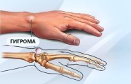 Гигрома: причины появления, симптоматика и эффективные методы лечения
