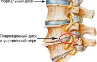 Дорсопатия: симптомы, причины появления, методы лечения