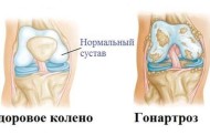 Гонартроз коленного сустава: причины появления, симптомы, методы лечения