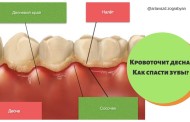 Чем лечить кровоточивость дёсен?