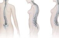 Лордоз: виды заболевания, причины появления, методы лечения