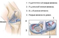 Мениск: виды повреждений, методы лечения, опасные последствия