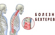 Болезнь Бехтерева: симптомы, причины появления и методы лечения