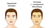 Что нужно знать о синдроме Жильбера