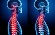 Лечение остеохондроза шейного отдела позвоночника: как вернуть себе здоровье и свободу движений