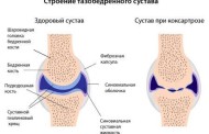 Артроз тазобедренного сустава
