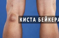 Киста Бейкера: причины появления, симптоматика, методы лечения