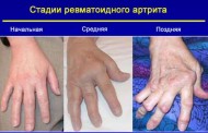 Ревматоидный артрит: симптомы заболевания и методы лечения