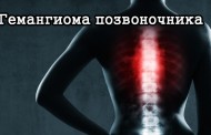 Гемангиома позвоночника: причины появления, эффективные методы лечения