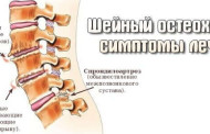 Остеохондроз шейного отдела: симптомы и методы лечения