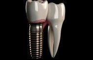 Имплантация зубов: новое решение для вашей улыбки