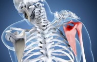 Как лечить плечевой остеохондроз и его симптомы