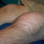Синовит коленного сустава: причины заболевания, правила лечения
