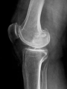 Лечение хондропатии хондропатия коленного сустава