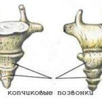 Крестцово-копчиковый остеохондроз