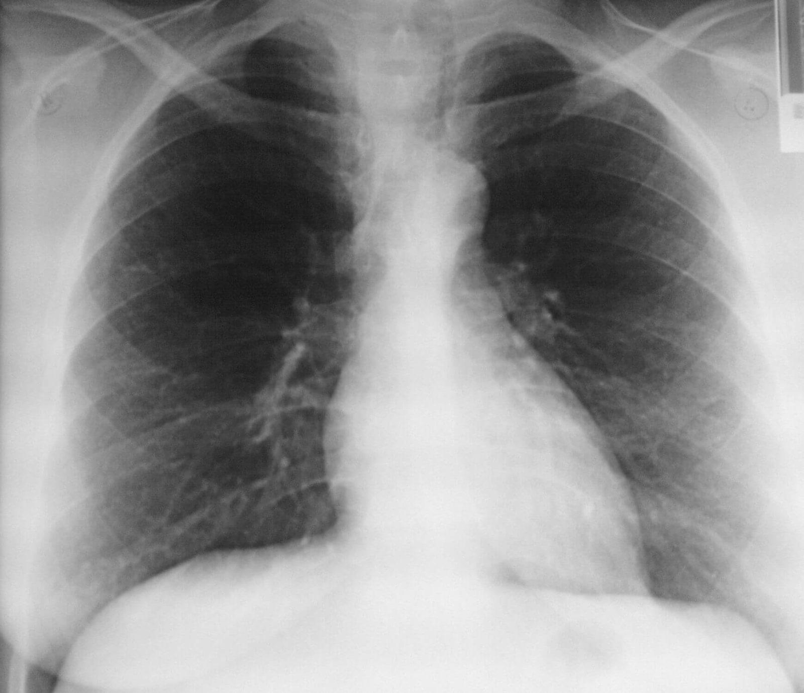 Хондродисплазия - экзостозная болезнь у детей, ахондродисплазия ...