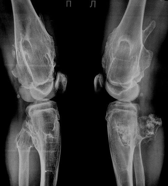 Хондродисплазия - экзостозная болезнь у детей, ахондродисплазия ...