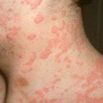 Крапивница