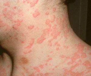 Крапивница