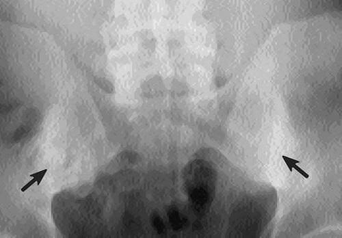 Остеосклероз - что это такое, субхондральный, суставных поверхностей