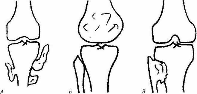 Хондродисплазия - экзостозная болезнь у детей, ахондродисплазия ...