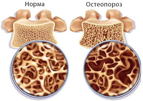 Заболевание остеопорозом