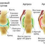 артрит и артроз