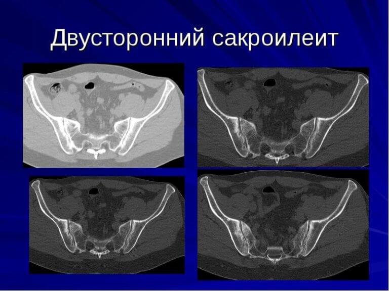 Сакроилеит - причины, симптомы, диагностика и лечение