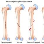 Виды переломов